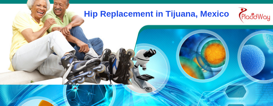 Hip Replacement in Tijuana, Mexico